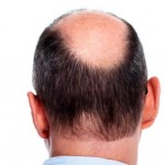 Tips mengatasi rambut rontok menggunakan minoxidil 5%